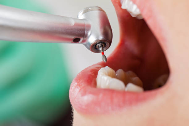 Best Emergency Tooth Extraction in Hearne, TX